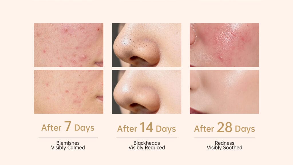 MR-2575 poster comparison grid showing facial skin areas after 7, 14, and 28 days.