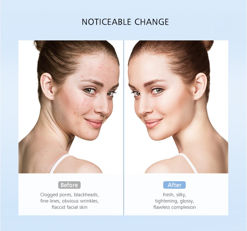 NICEMAY BJ-1809 facial skin scrubber before and after concept